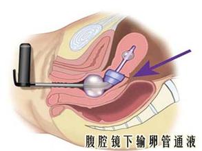 输卵管该如何治疗