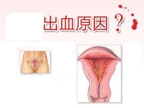 阴道出血褐色是什么原因