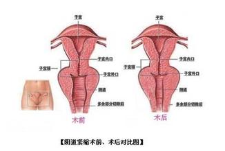 阴道松弛怎么办?